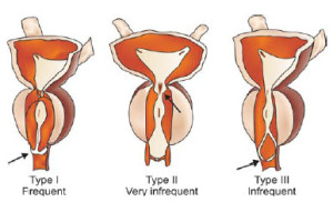 后尿道瓣膜分型图解